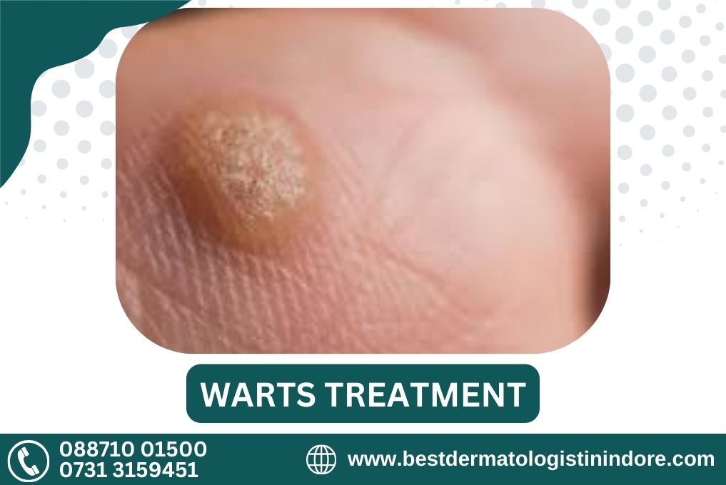 Best Periungual Warts Specialist in Indore